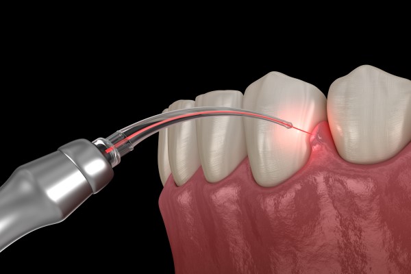 Laser Dentistry