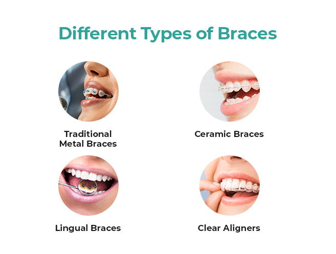 Braces / Orthodontic treatment