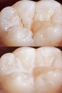Pit and Fissure Sealants