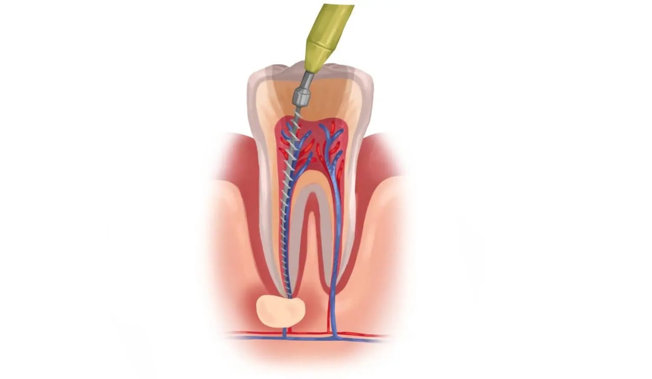 Root Canal treatment in Ramamurthy Nagar