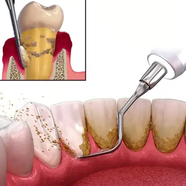 Scaling / Teeth Cleaning